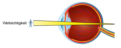 Weitsichtigkeit / Hyperopie