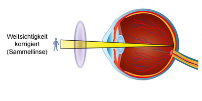 Weitsichtigkeit / Hyperopie